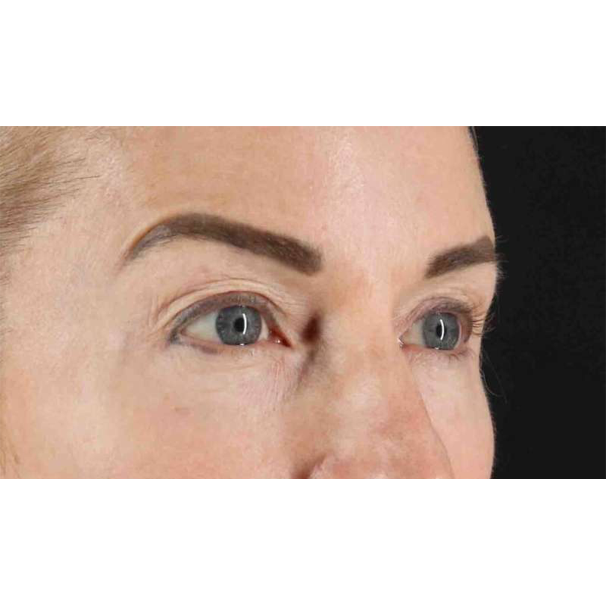 Eyelid Surgery Before & After Patient #1869