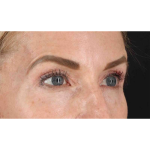 Eyelid Surgery Before & After Patient #1869