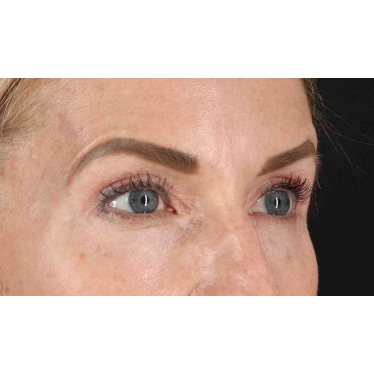 Eyelid Surgery Before & After Patient #1869