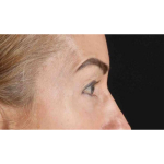 Eyelid Surgery Before & After Patient #1869