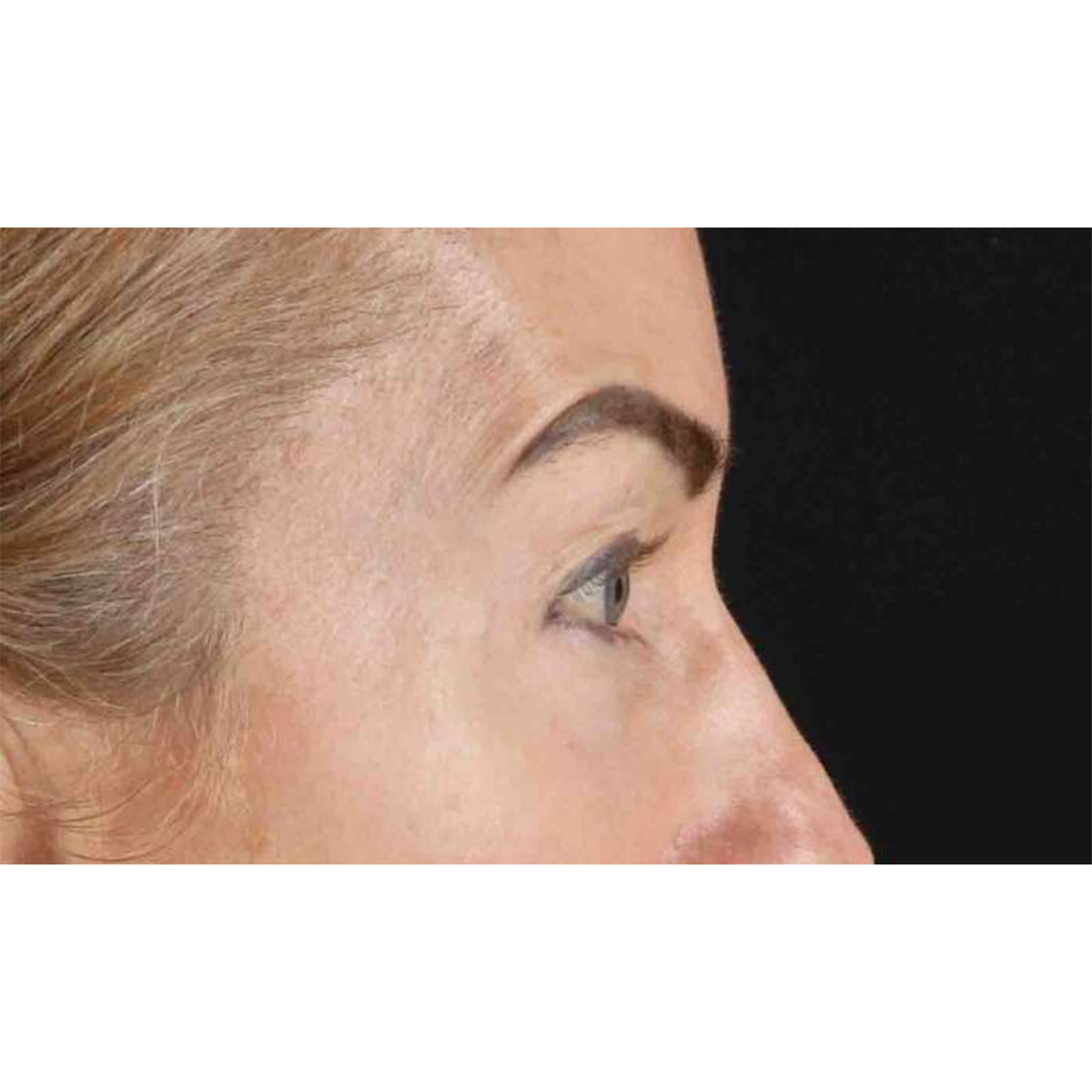Eyelid Surgery Before & After Patient #1869