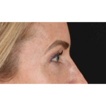 Eyelid Surgery Before & After Patient #1869