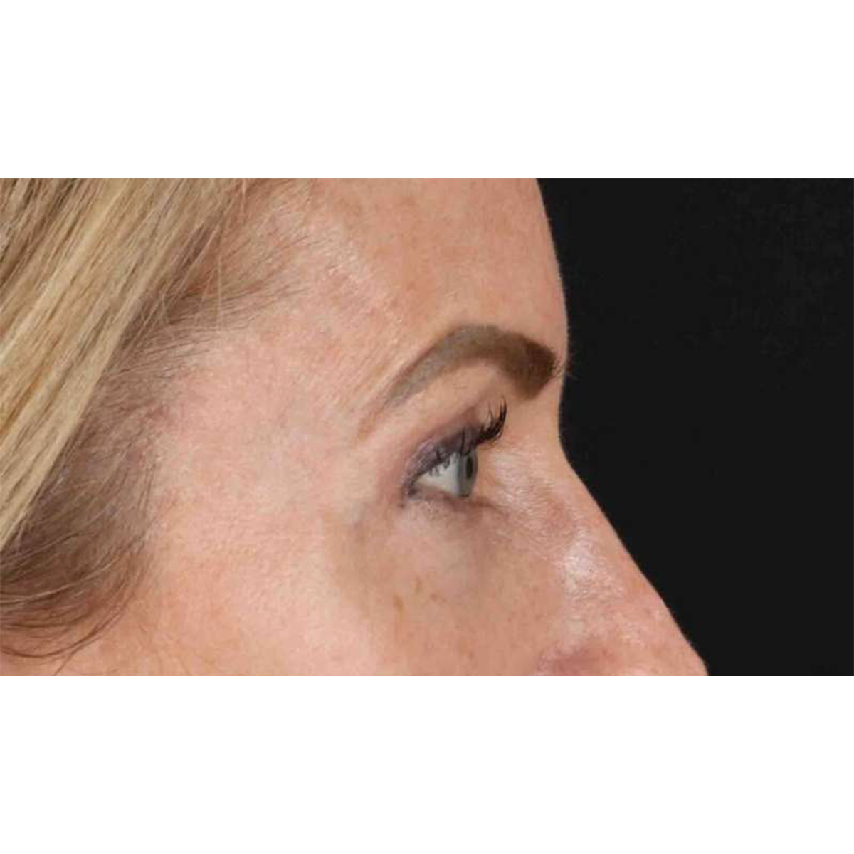 Eyelid Surgery Before & After Patient #1869