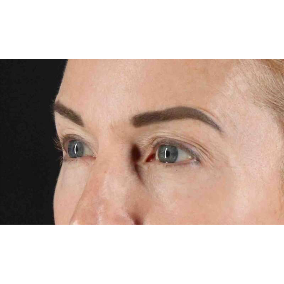 Eyelid Surgery Before & After Patient #1869