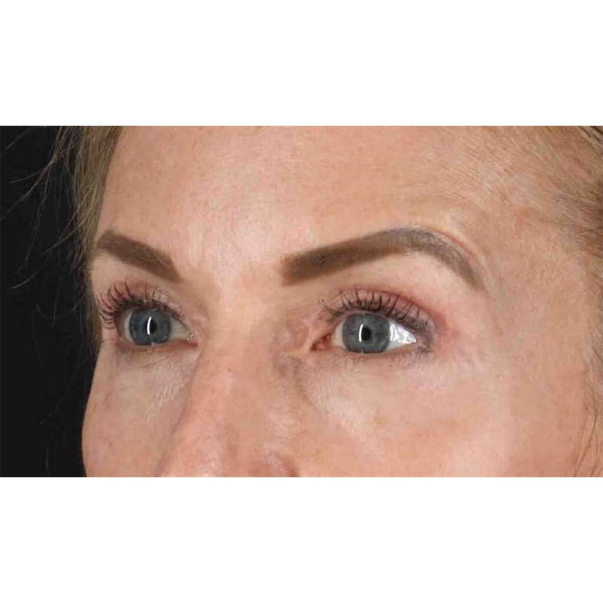 Eyelid Surgery Before & After Patient #1869