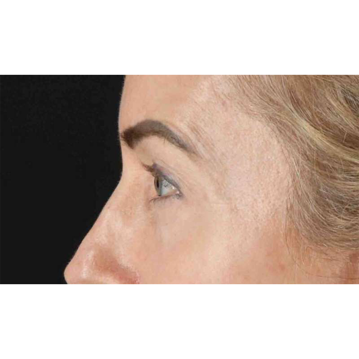 Eyelid Surgery Before & After Patient #1869