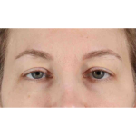 Eyelid Surgery Before & After Patient #1880