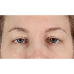 Eyelid Surgery Before & After Patient #1880