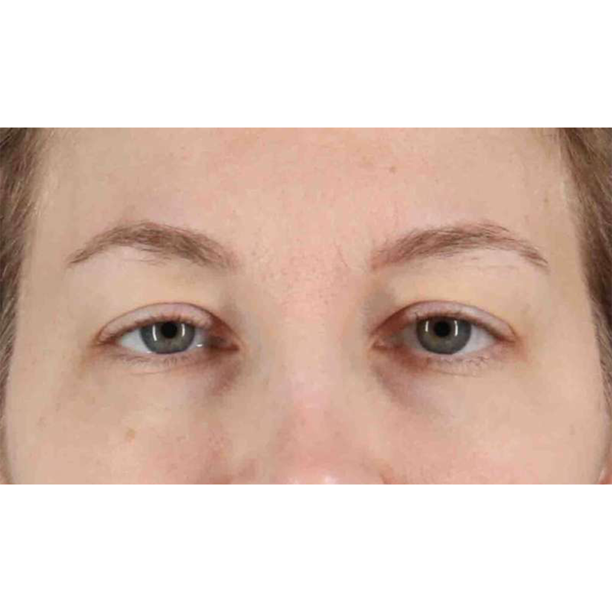 Eyelid Surgery Before & After Patient #1880