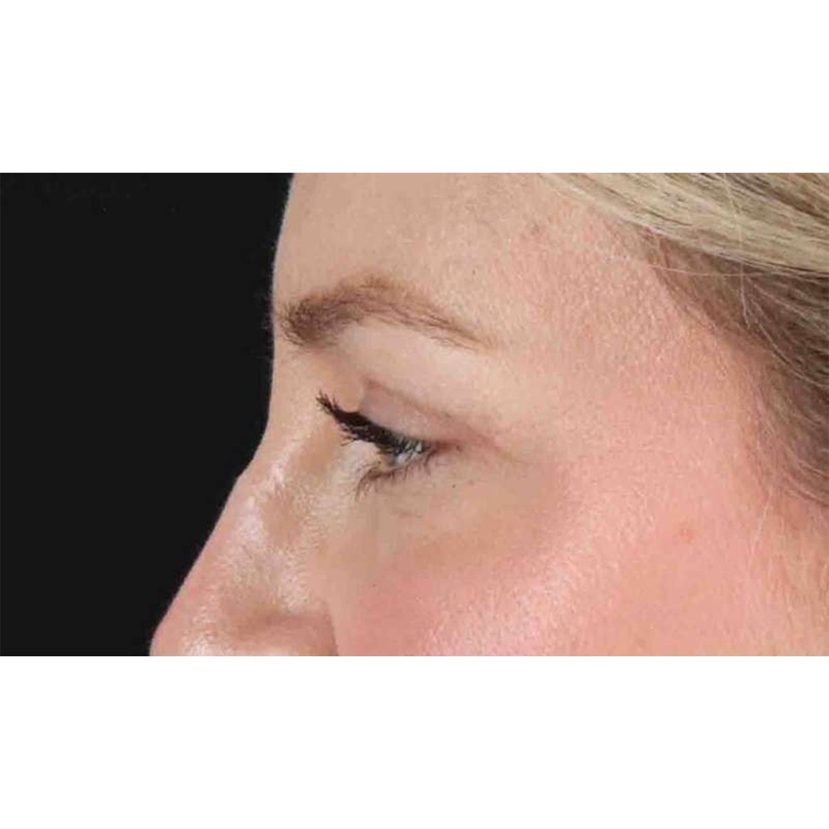 Eyelid Surgery Before & After Patient #1880