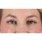 Eyelid Surgery Before & After Patient #1880