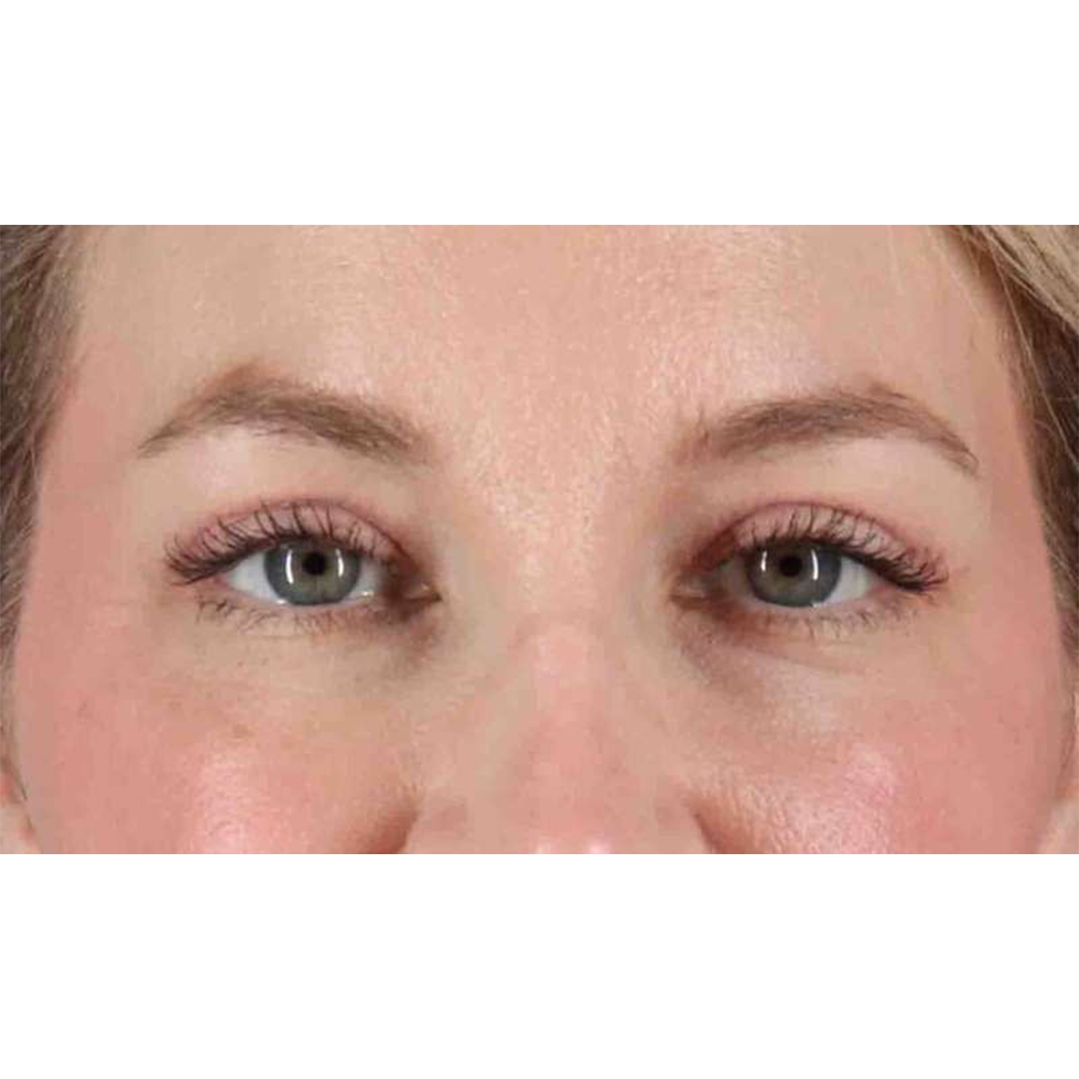 Eyelid Surgery Before & After Patient #1880