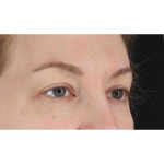 Eyelid Surgery Before & After Patient #1880