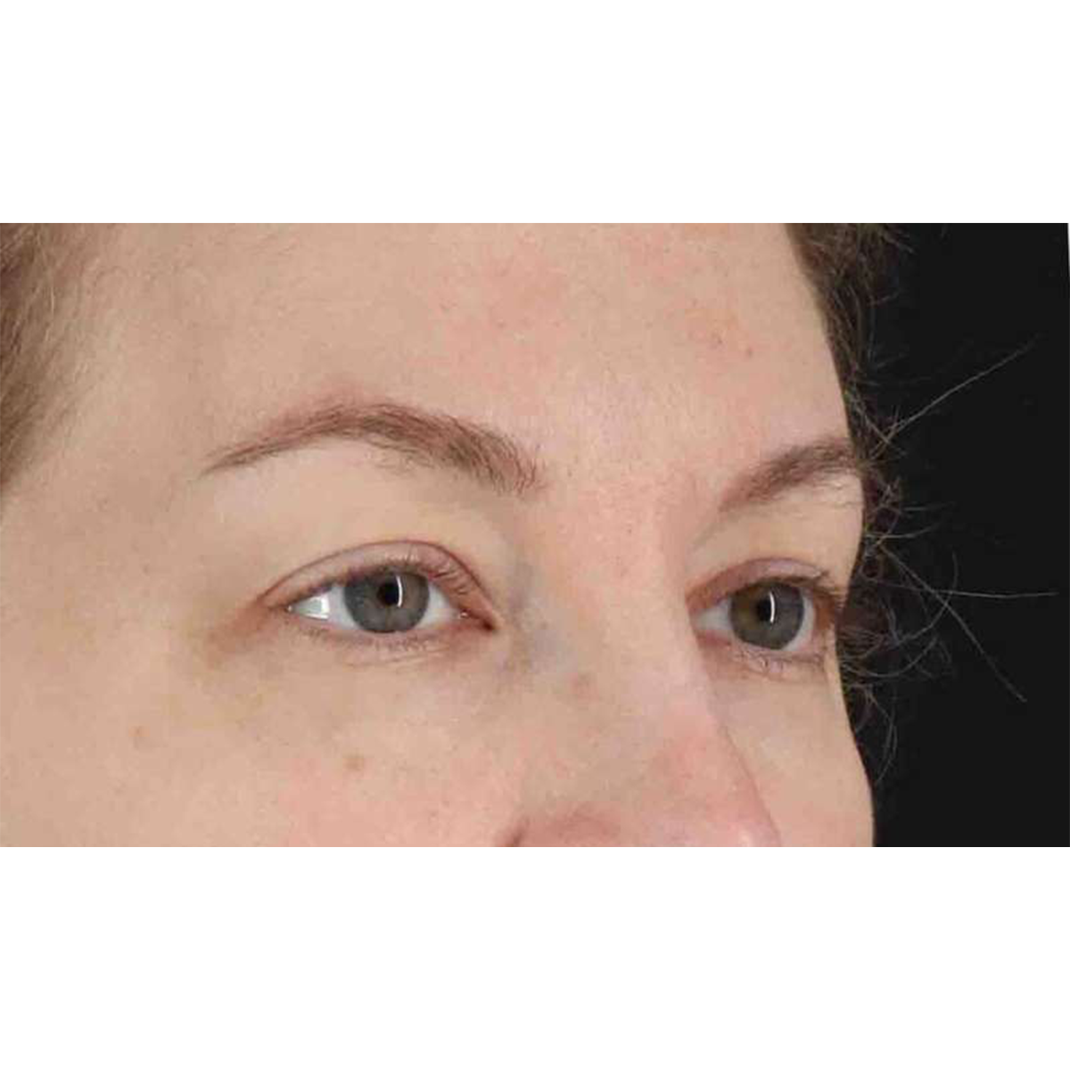 Eyelid Surgery Before & After Patient #1880