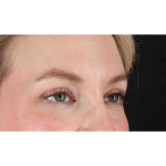 Eyelid Surgery Before & After Patient #1880