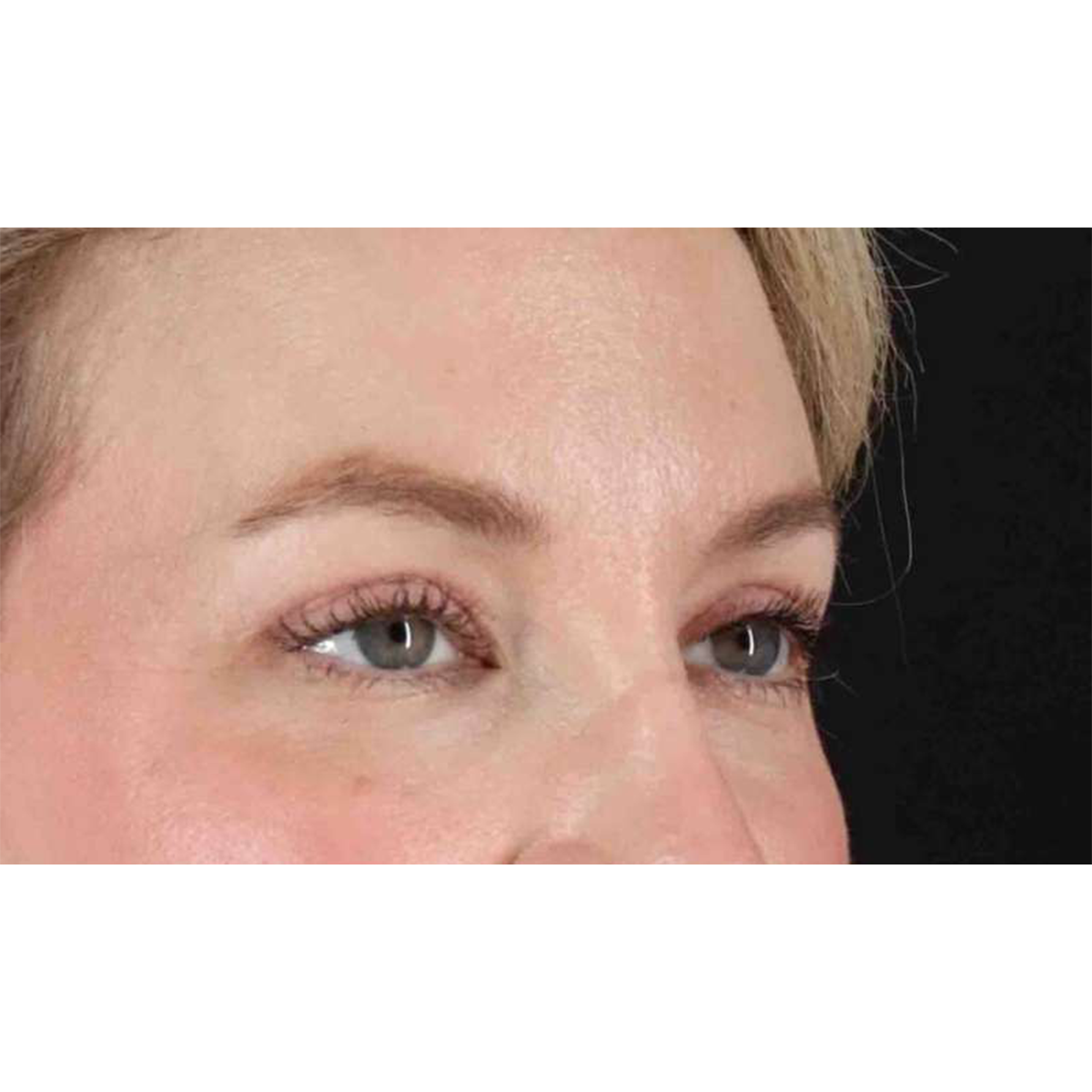 Eyelid Surgery Before & After Patient #1880