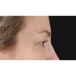 Eyelid Surgery Before & After Patient #1880