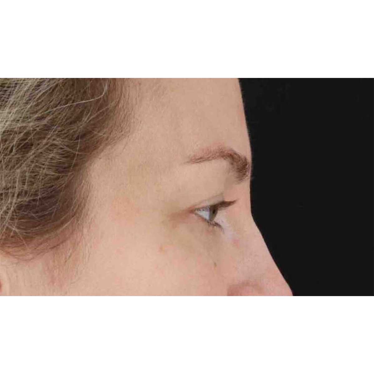 Eyelid Surgery Before & After Patient #1880