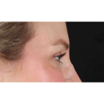 Eyelid Surgery Before & After Patient #1880