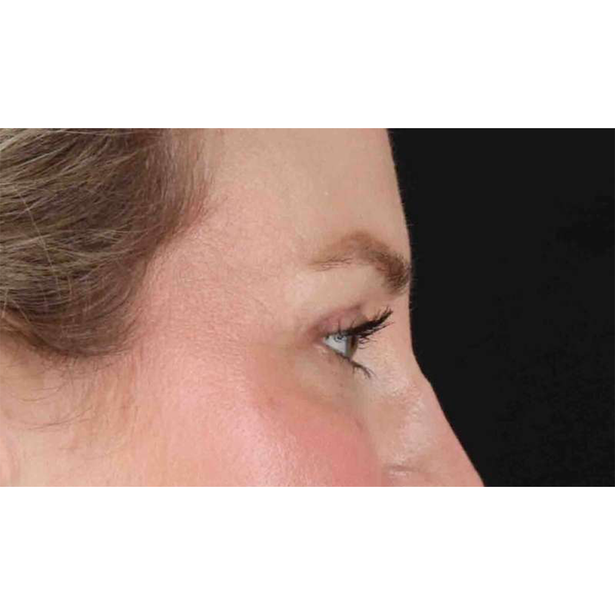 Eyelid Surgery Before & After Patient #1880