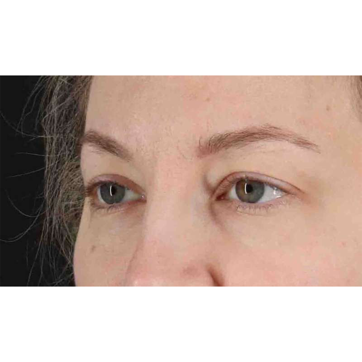 Eyelid Surgery Before & After Patient #1880