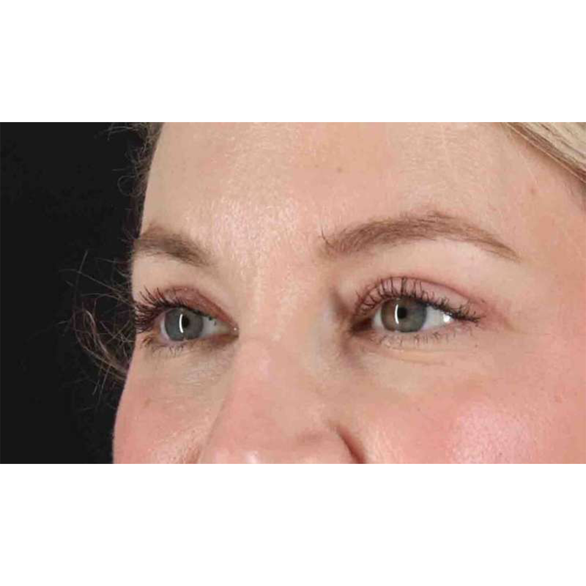 Eyelid Surgery Before & After Patient #1880