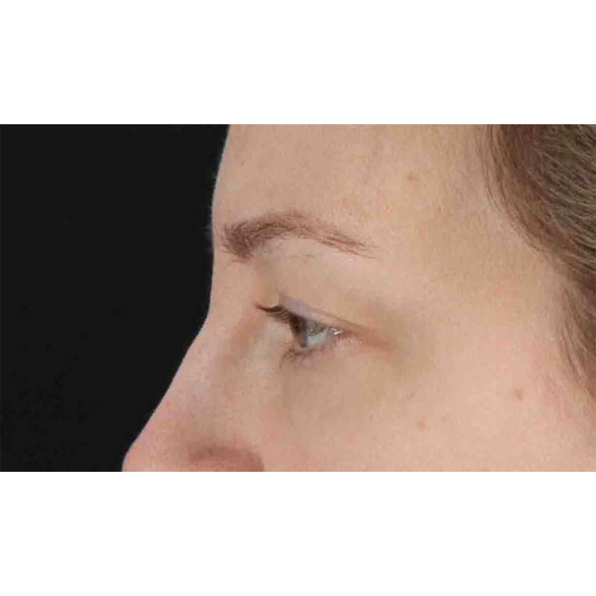 Eyelid Surgery Before & After Patient #1880