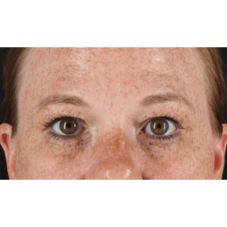 Eyelid Surgery Before & After Patient #1891