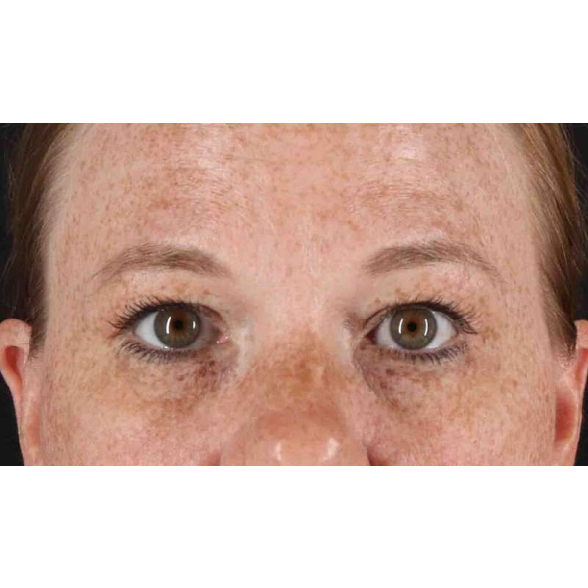 Eyelid Surgery Before & After Patient #1891
