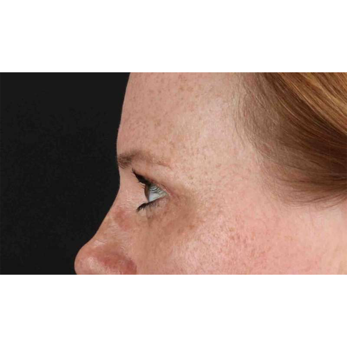Eyelid Surgery Before & After Patient #1891