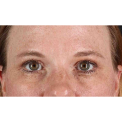Eyelid Surgery Before & After Patient #1891