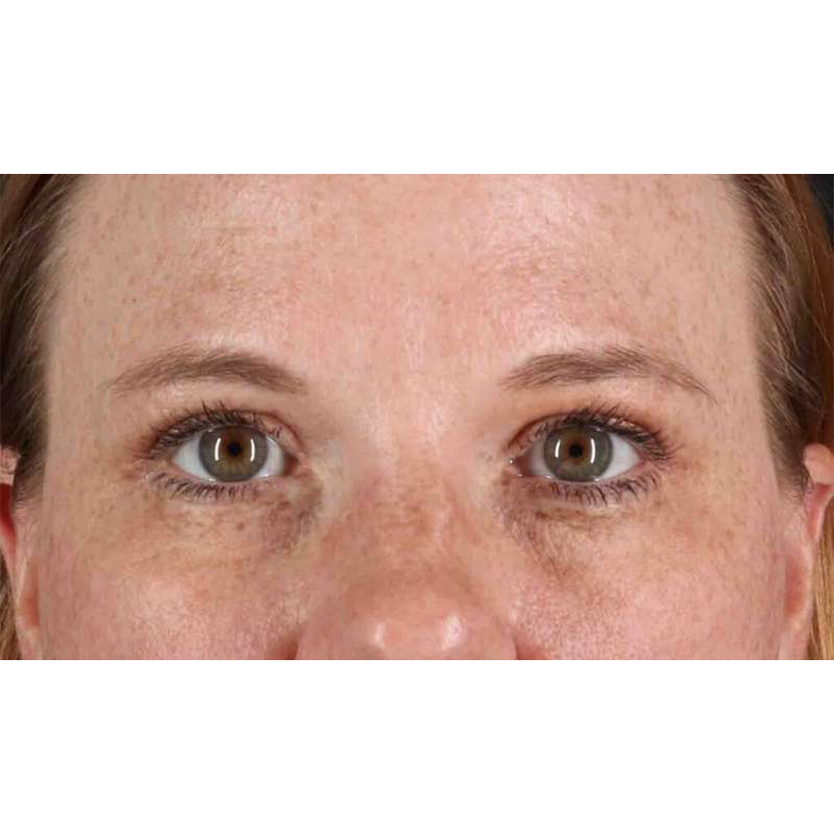 Eyelid Surgery Before & After Patient #1891