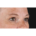 Eyelid Surgery Before & After Patient #1891