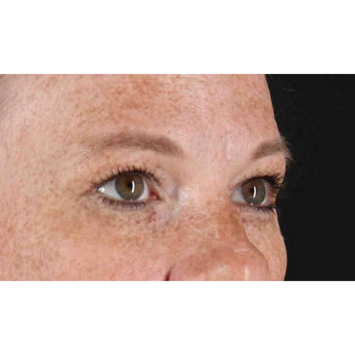 Eyelid Surgery Before & After Patient #1891