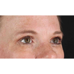 Eyelid Surgery Before & After Patient #1891