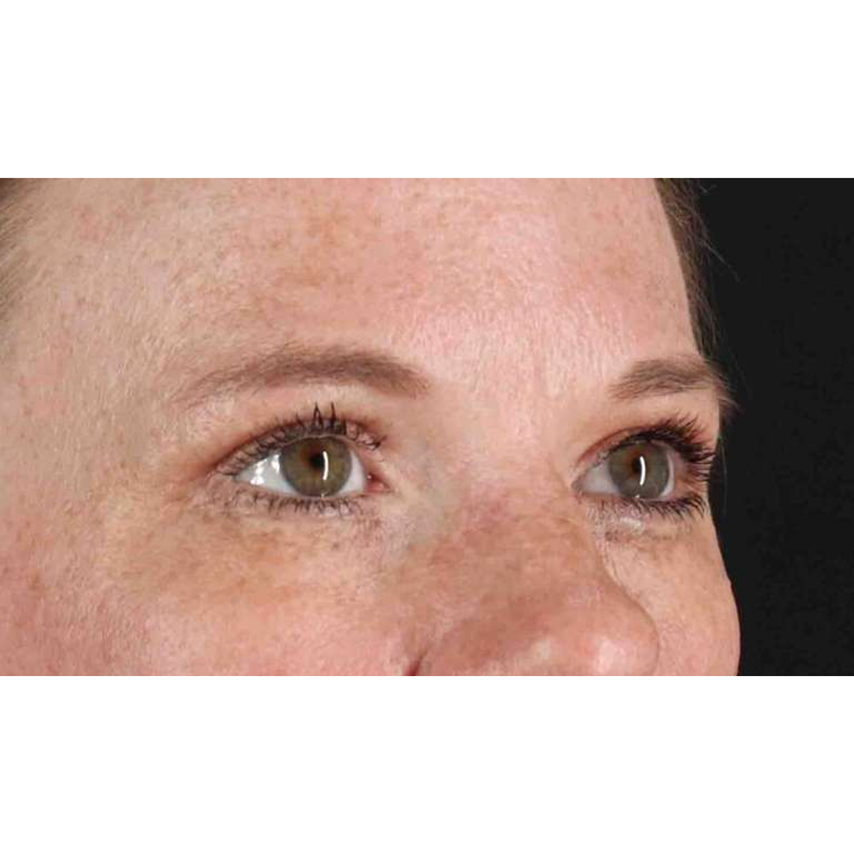 Eyelid Surgery Before & After Patient #1891