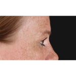 Eyelid Surgery Before & After Patient #1891