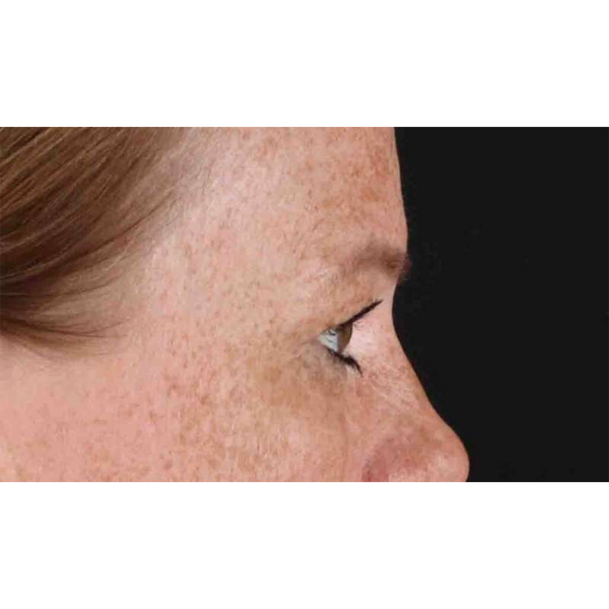 Eyelid Surgery Before & After Patient #1891