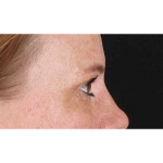 Eyelid Surgery Before & After Patient #1891