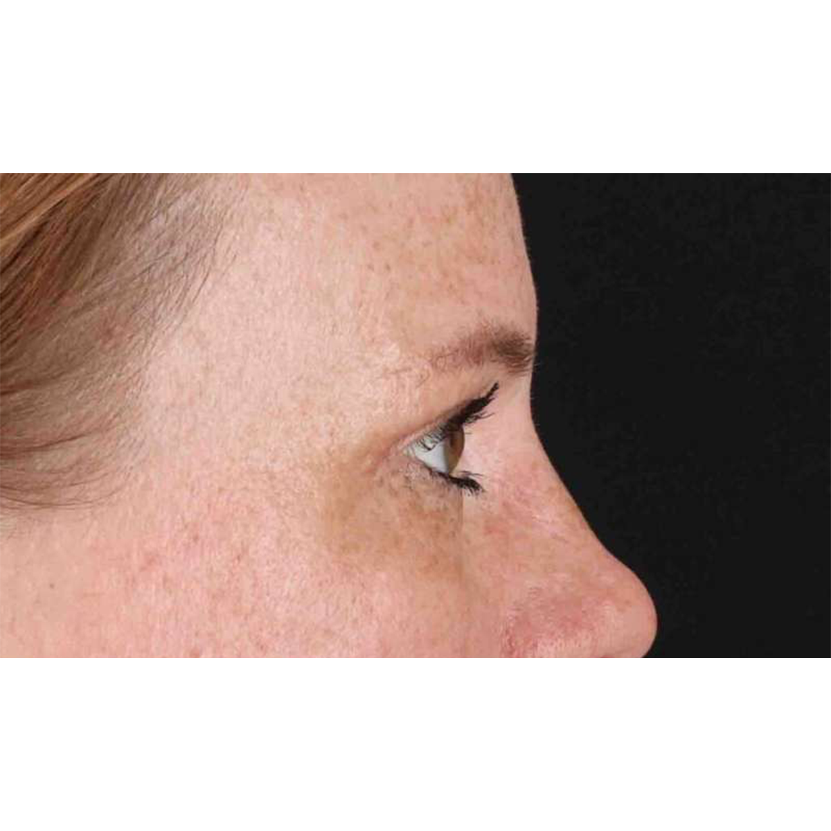 Eyelid Surgery Before & After Patient #1891