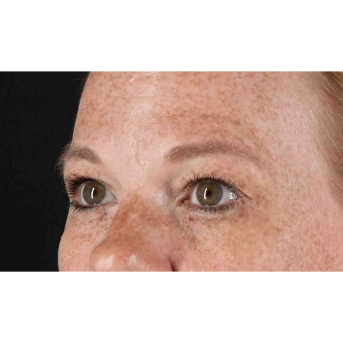 Eyelid Surgery Before & After Patient #1891