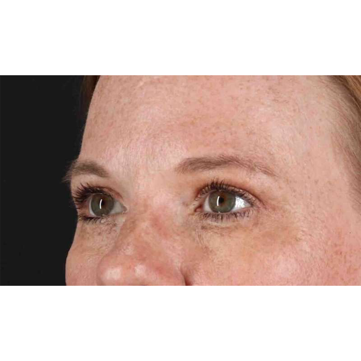 Eyelid Surgery Before & After Patient #1891