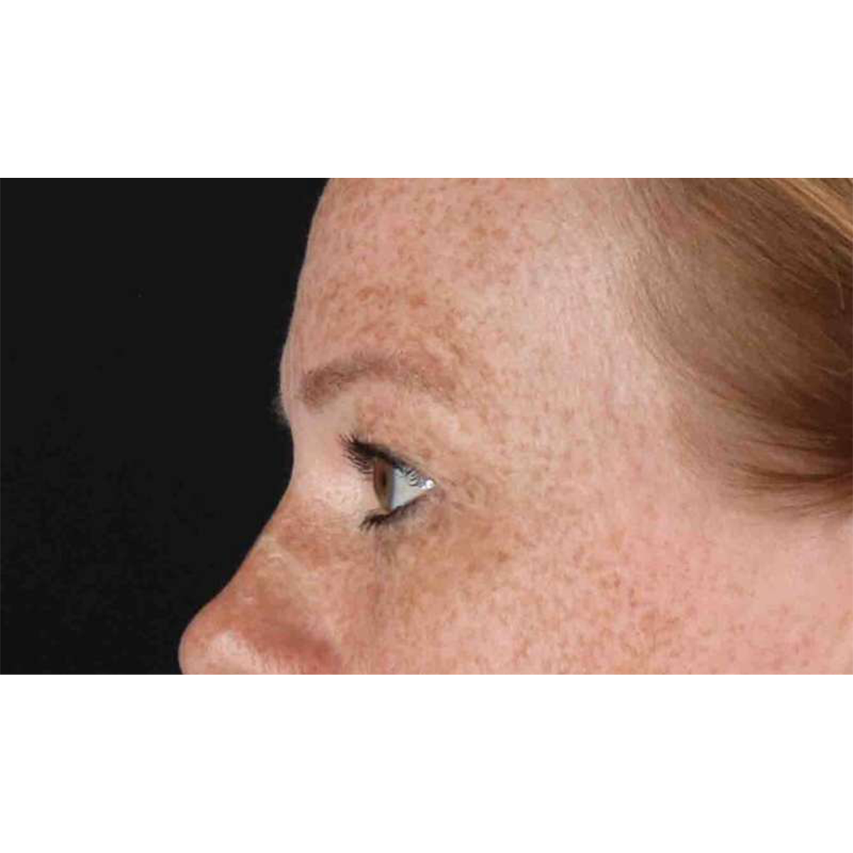 Eyelid Surgery Before & After Patient #1891