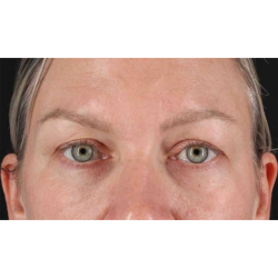 Eyelid Surgery Before & After Patient #1902