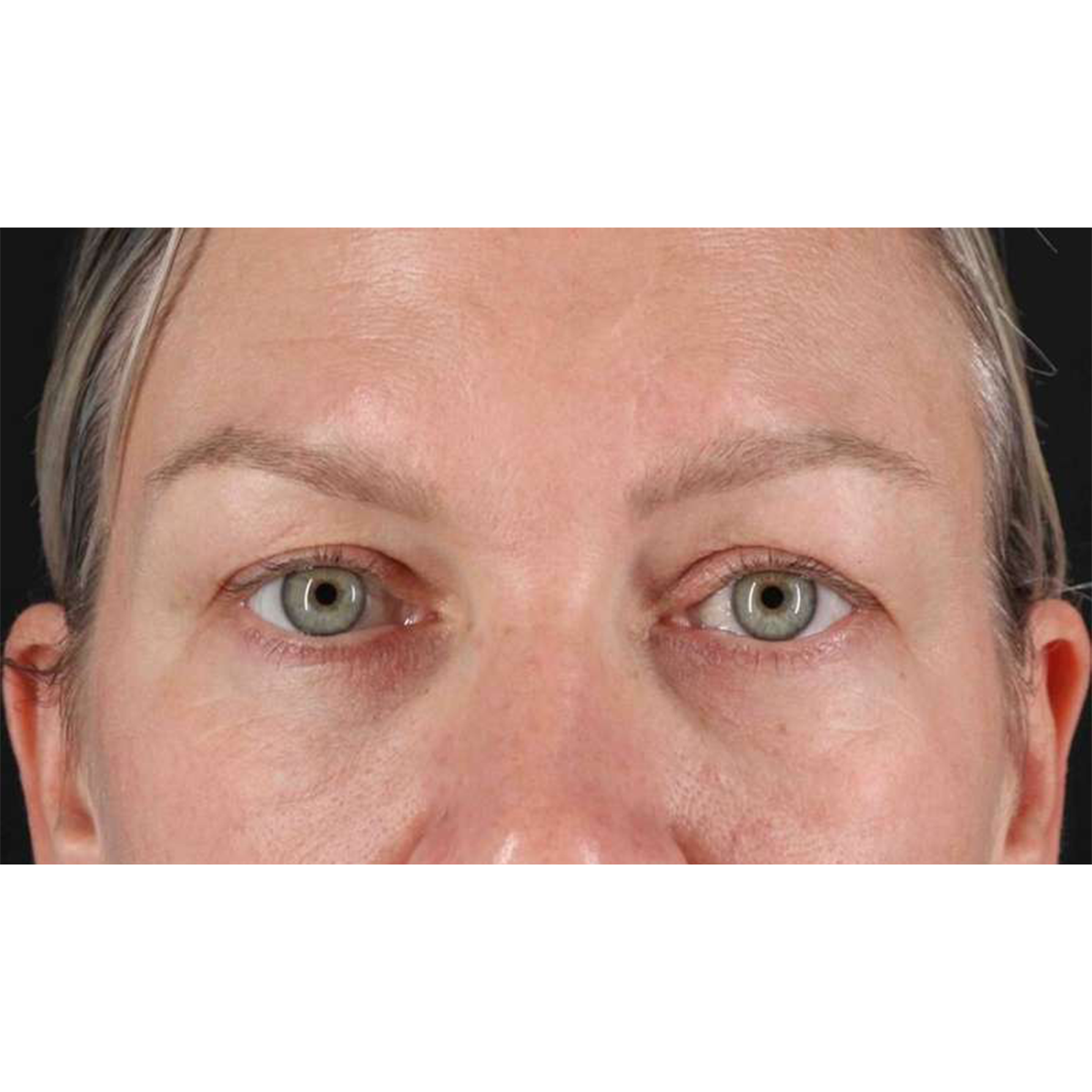 Eyelid Surgery Before & After Patient #1902