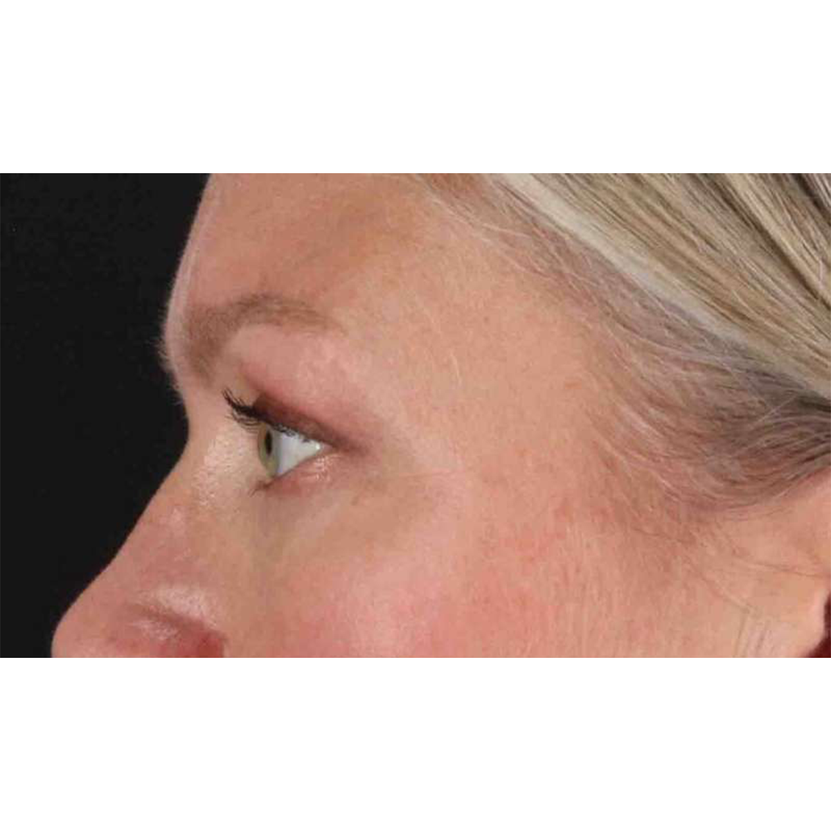 Eyelid Surgery Before & After Patient #1902
