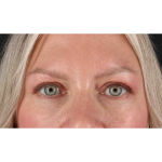 Eyelid Surgery Before & After Patient #1902