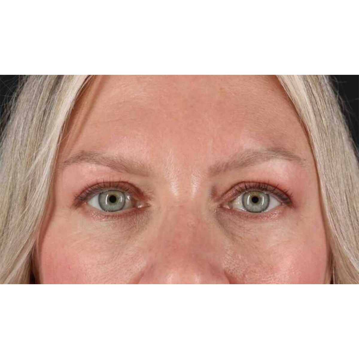 Eyelid Surgery Before & After Patient #1902