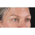 Eyelid Surgery Before & After Patient #1902