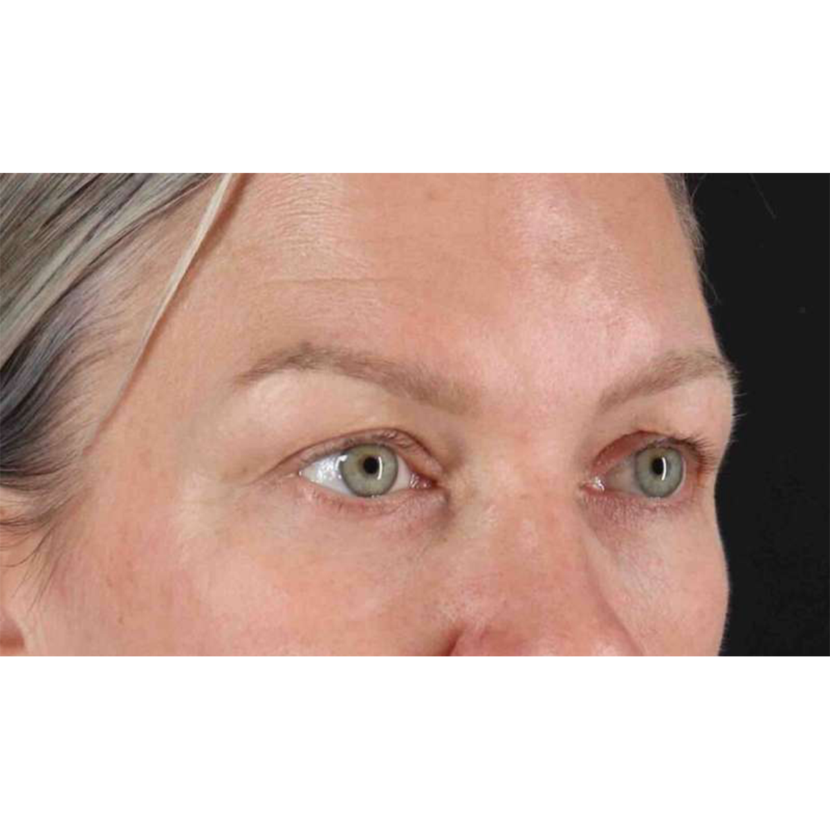 Eyelid Surgery Before & After Patient #1902